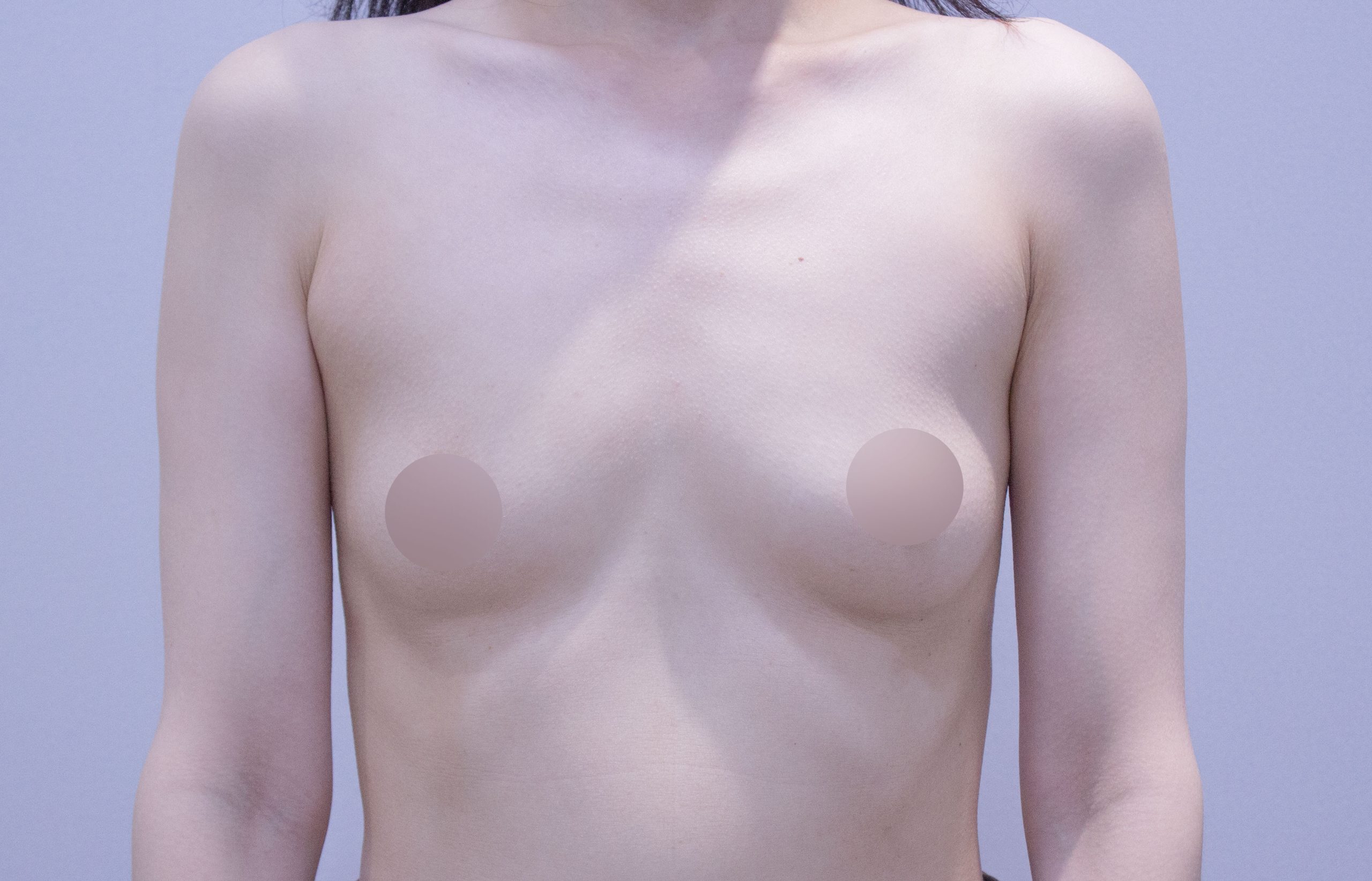 breast implant before after korea