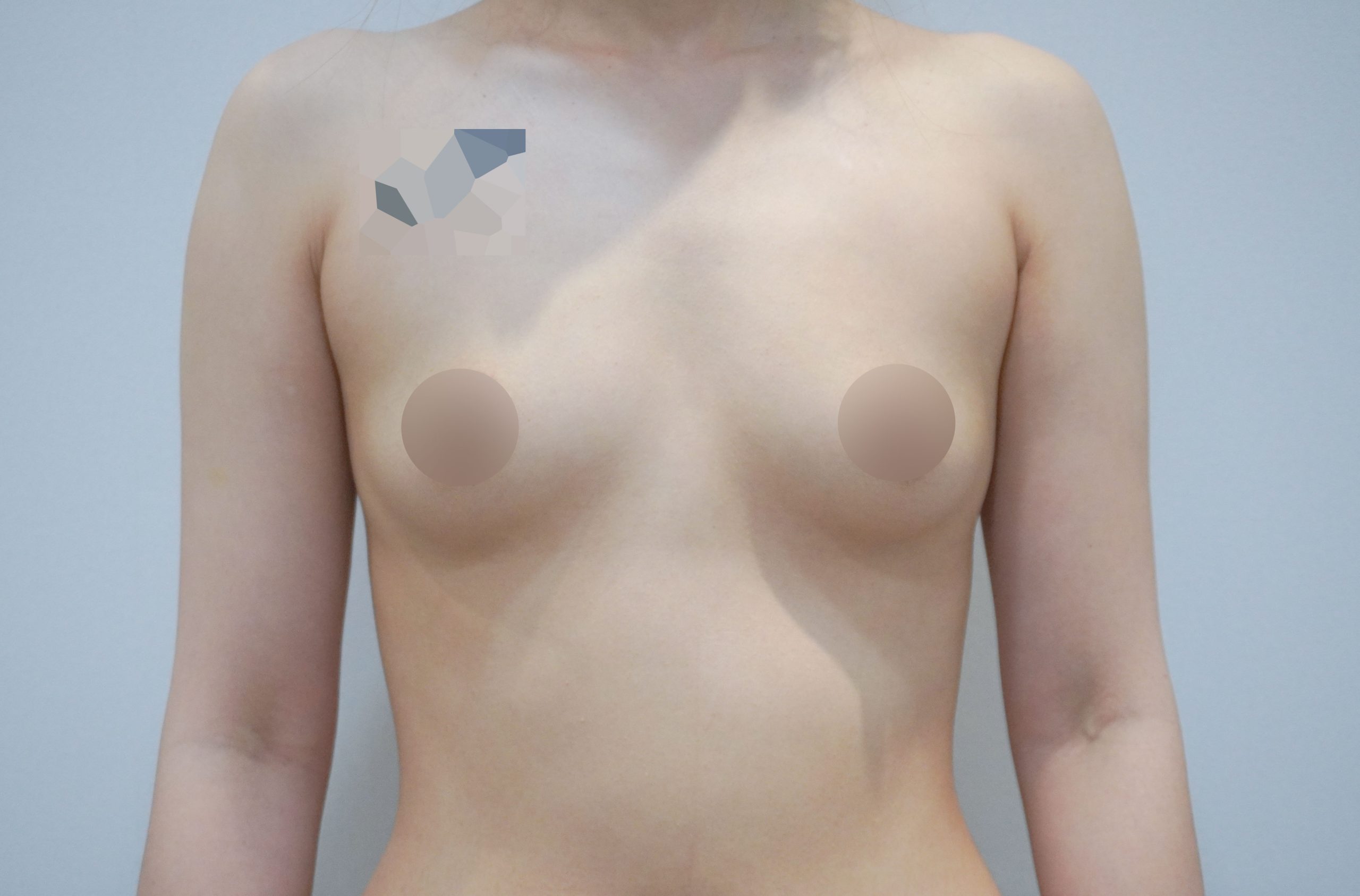 breast implant before after korea