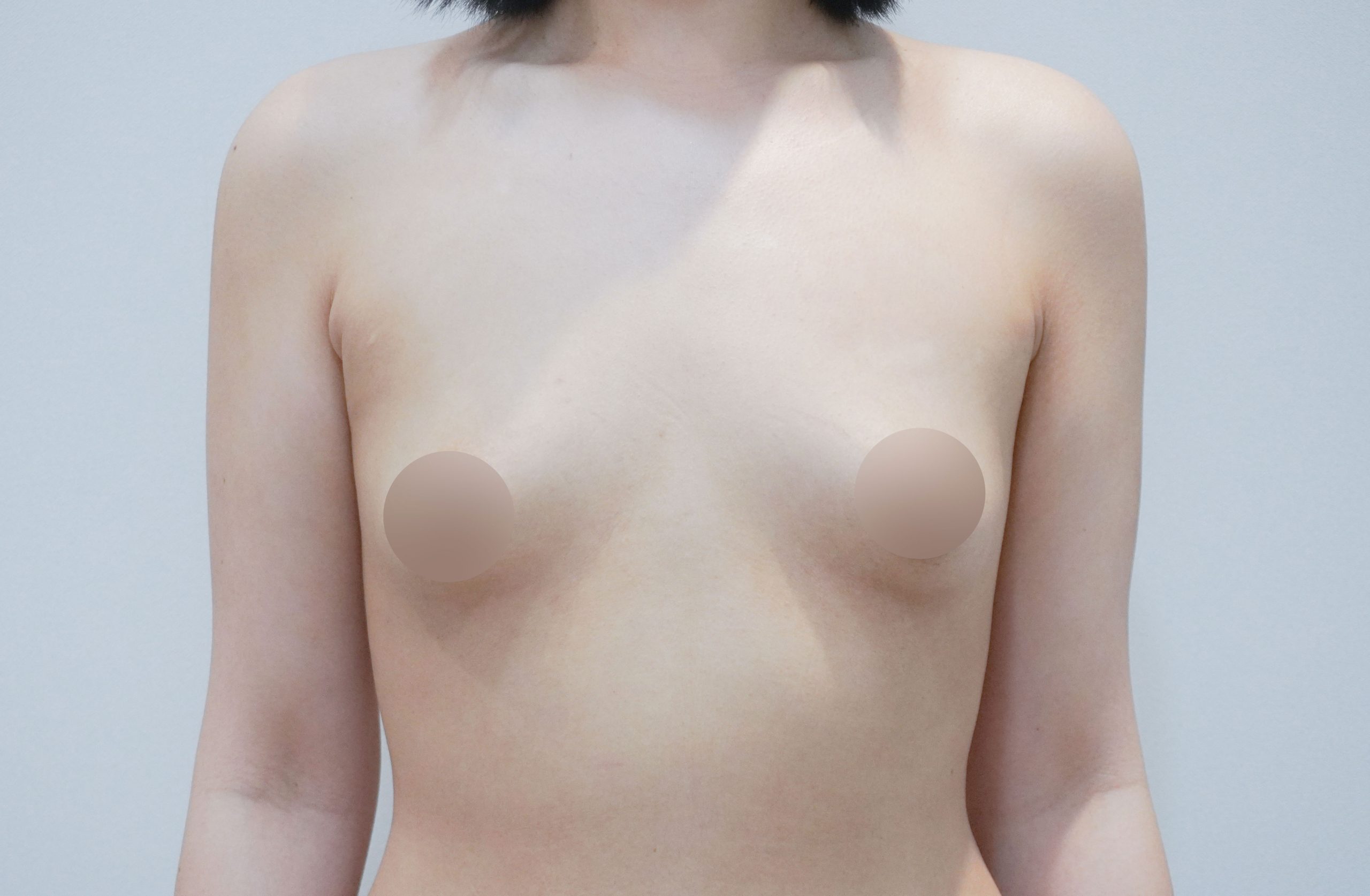 breast implant before after korea