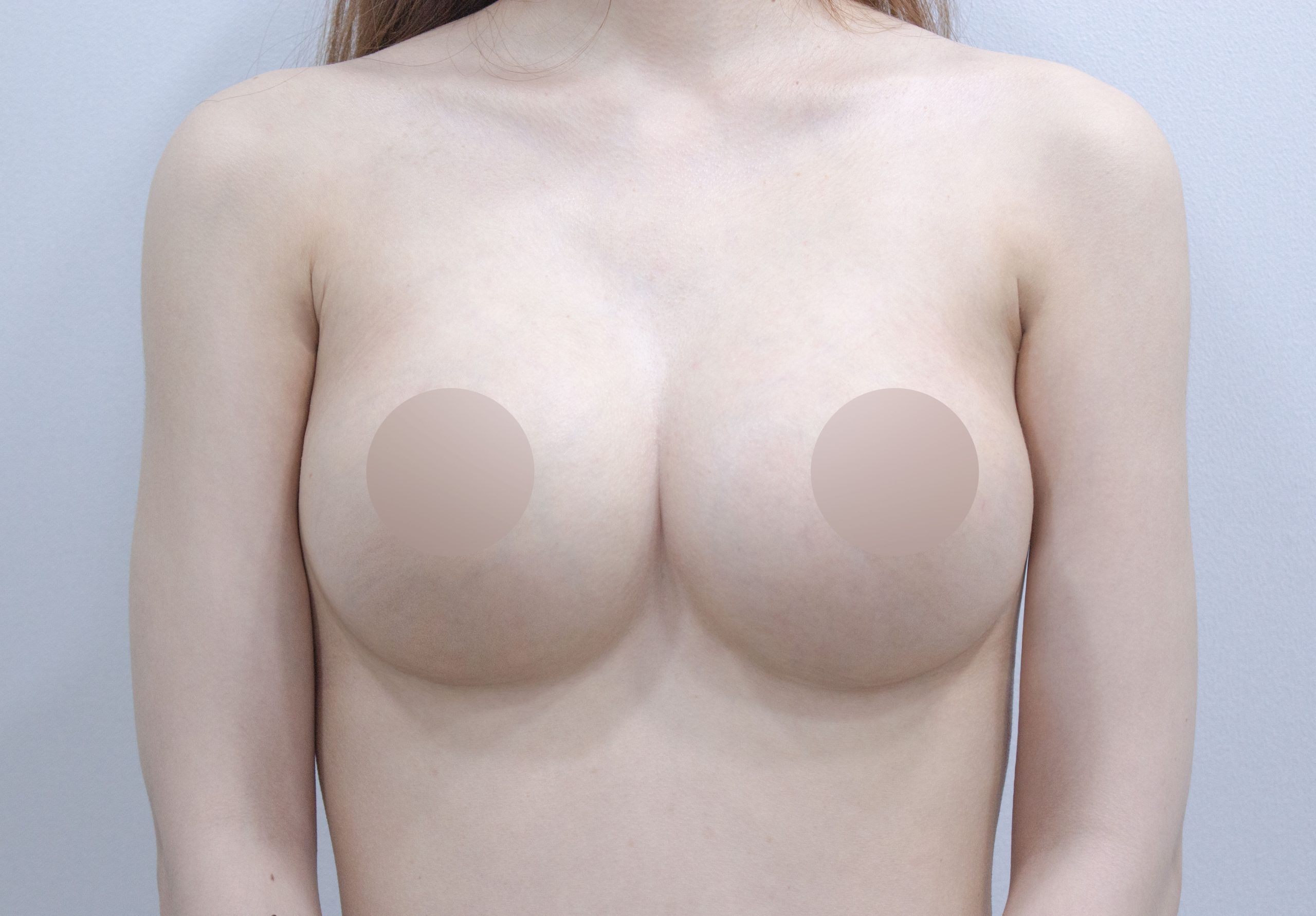 breast implant before after korea