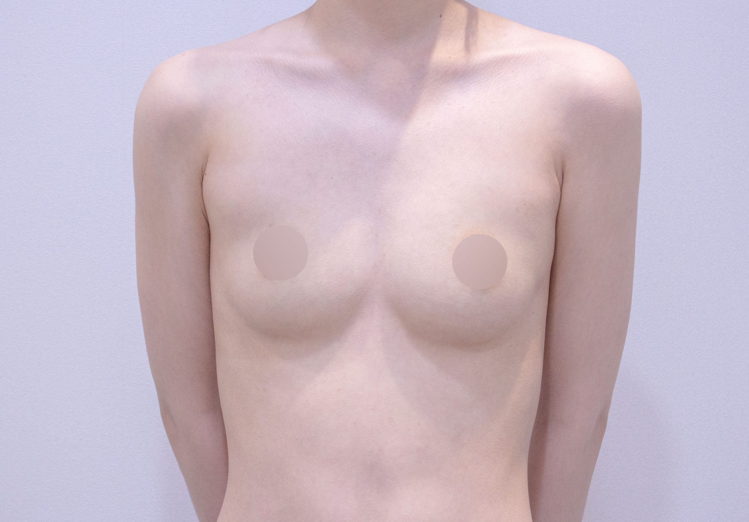 breast implant before after korea