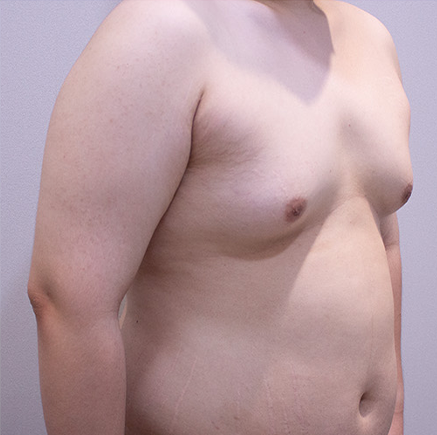 Gynecomastia korea