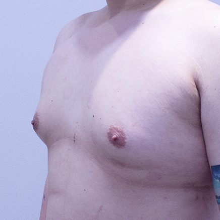 Gynecomastia korea