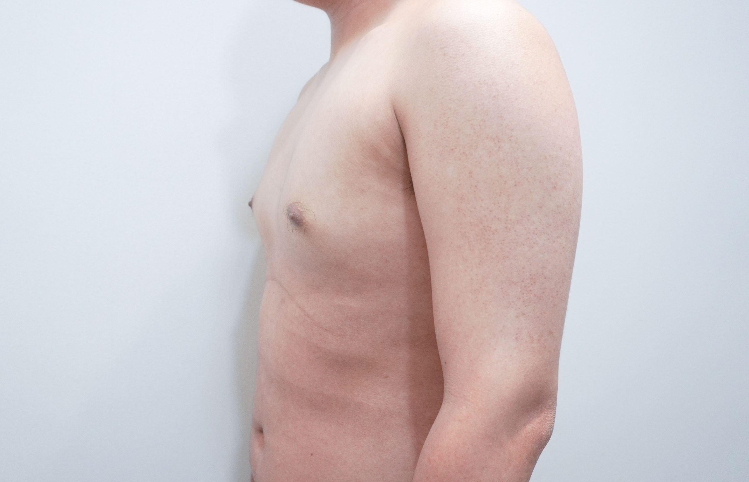 Gynecomastia korea