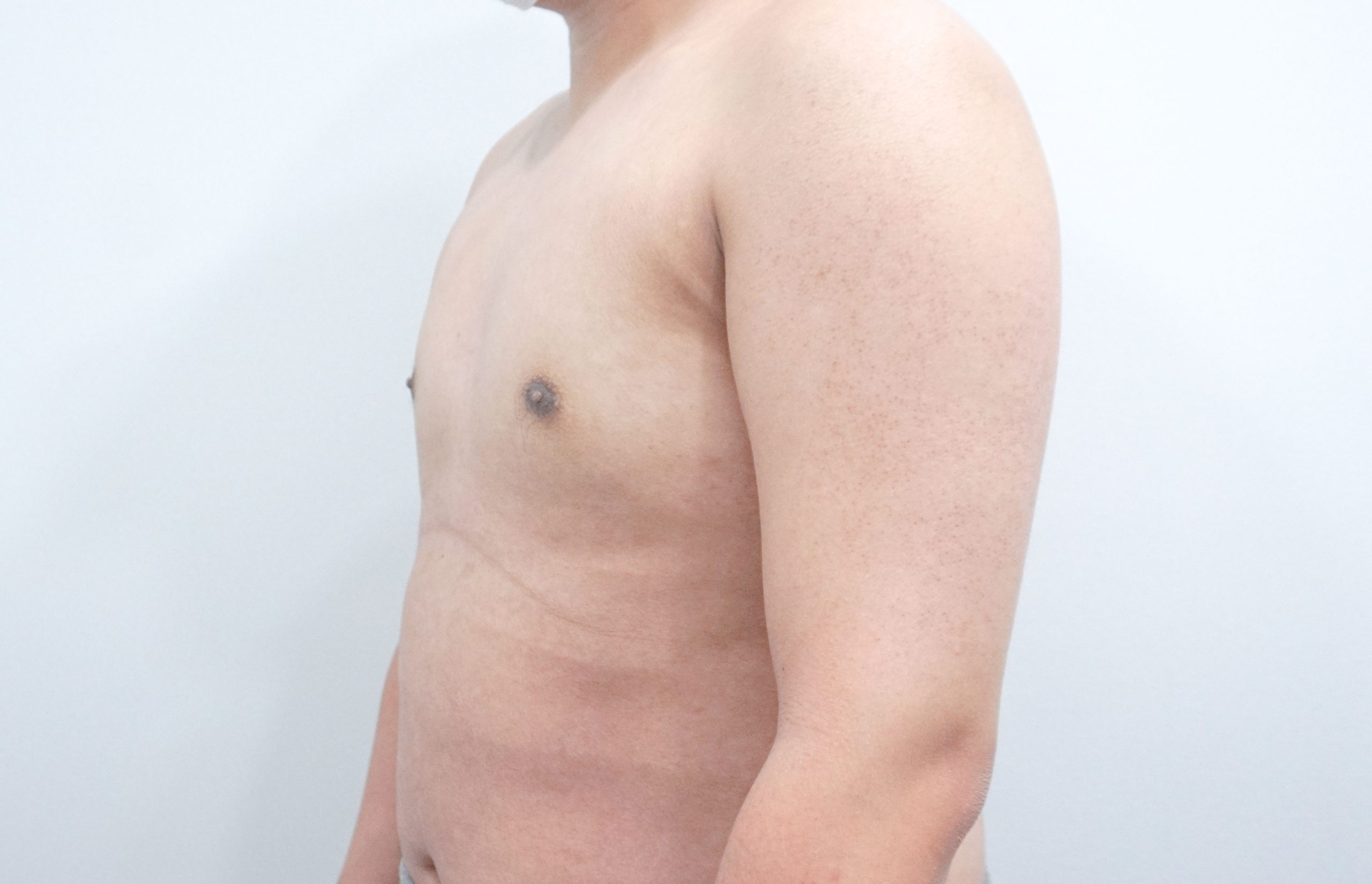 Gynecomastia korea