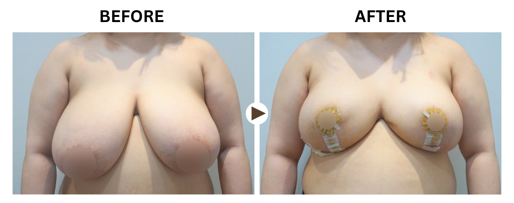 breast reduction korea before after