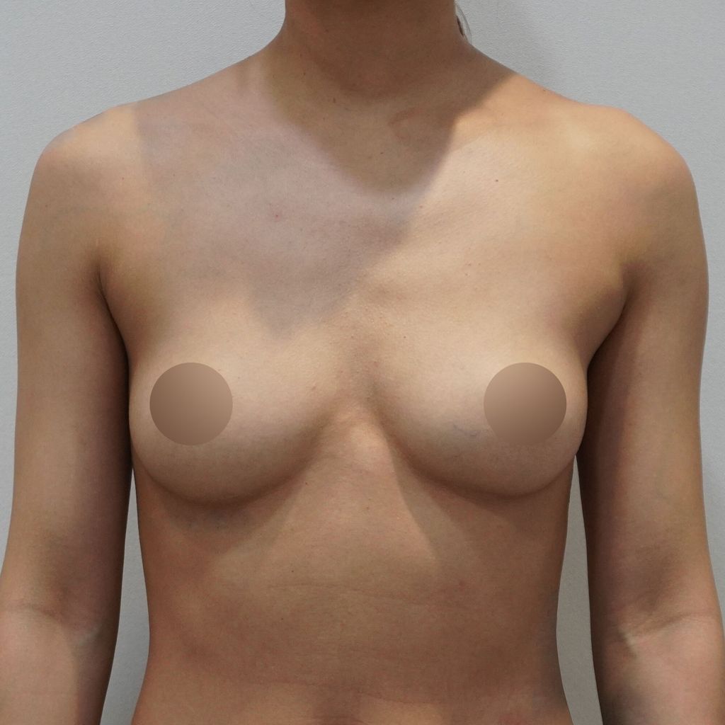 motiva breast implant review korea 